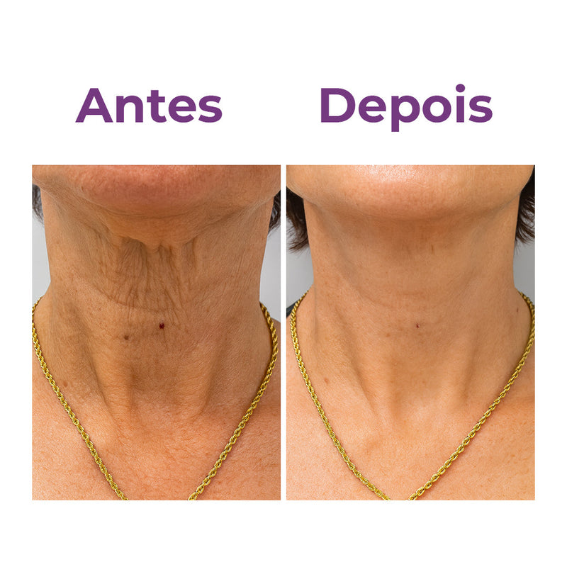 Neckfit - Adesivo para rugas e flacidez do pescoço