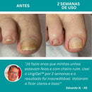 UngiGel - Adesivos para fungos