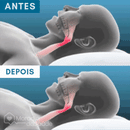 (COMPRE 1 LEVE 3) Protetor Bucal Anti-Ronco Znorex®