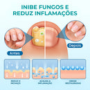 UngiGel - Adesivos para fungos