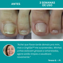 UngiGel - Adesivos para fungos