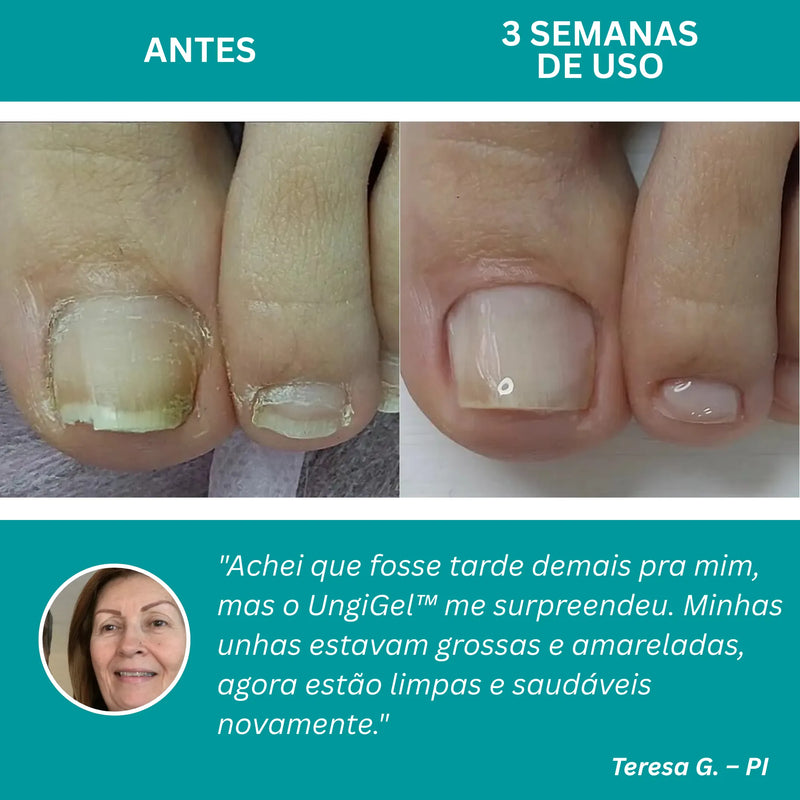 UngiGel - Adesivos para fungos