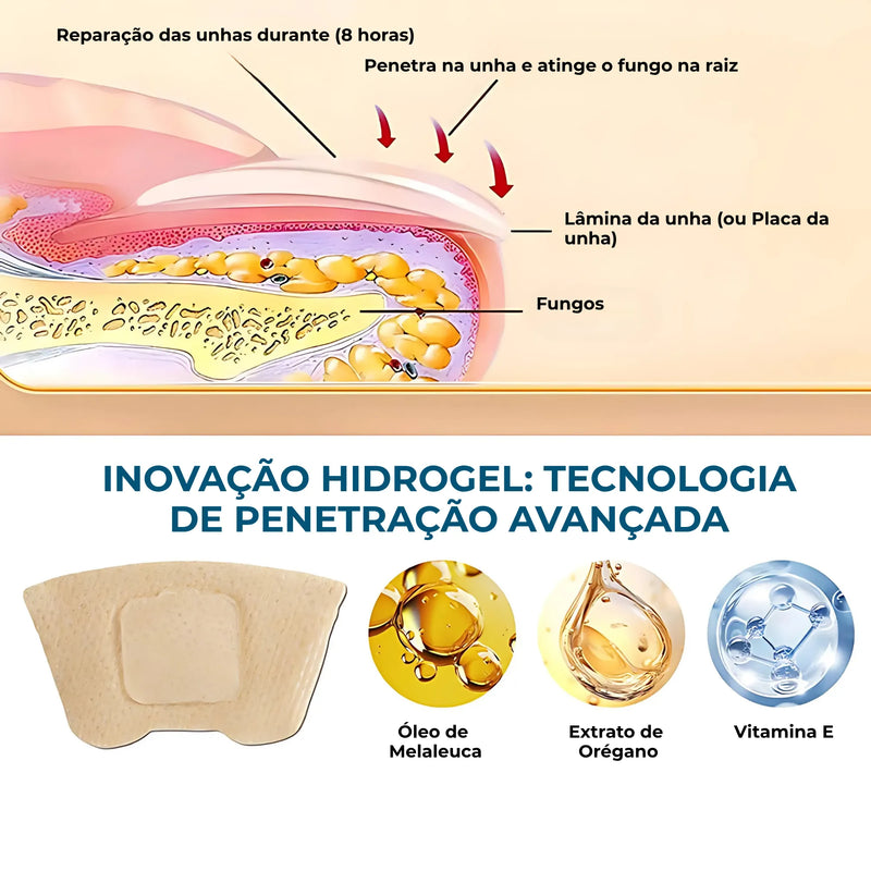 UngiGel - Adesivos para fungos